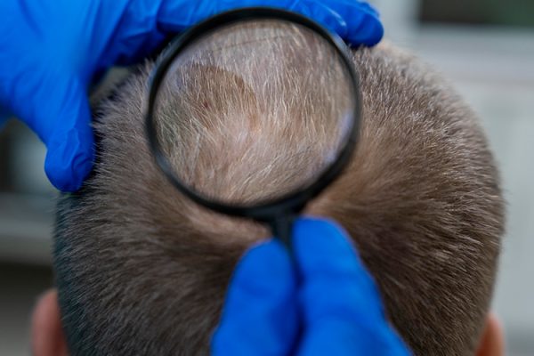 Saç Dökülmesini Durduran ve Yeni Saç Çıkaran Doğal Maske Tarifleri